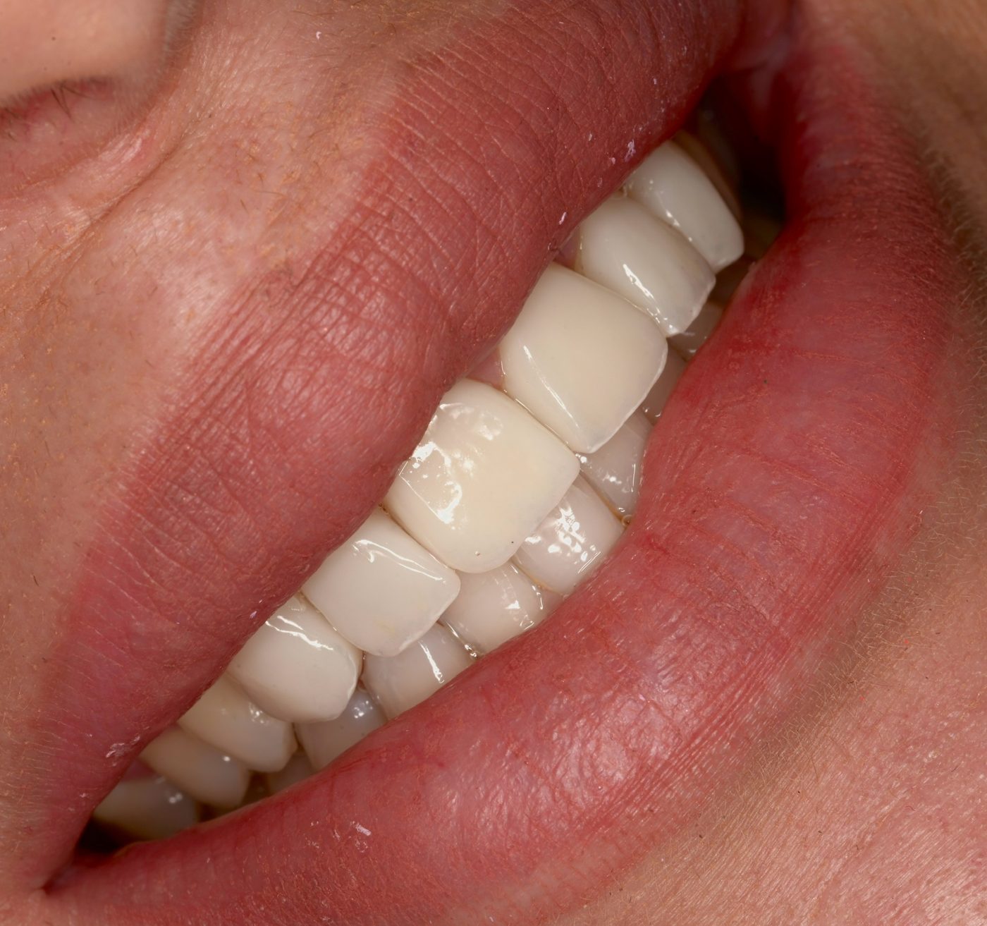 Sorriso con protesi fissa nel settore anteriore